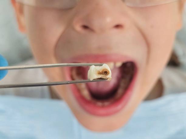 Best Emergency Dental Extractions in Independence, OR